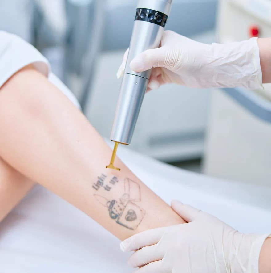Tattoo removal
