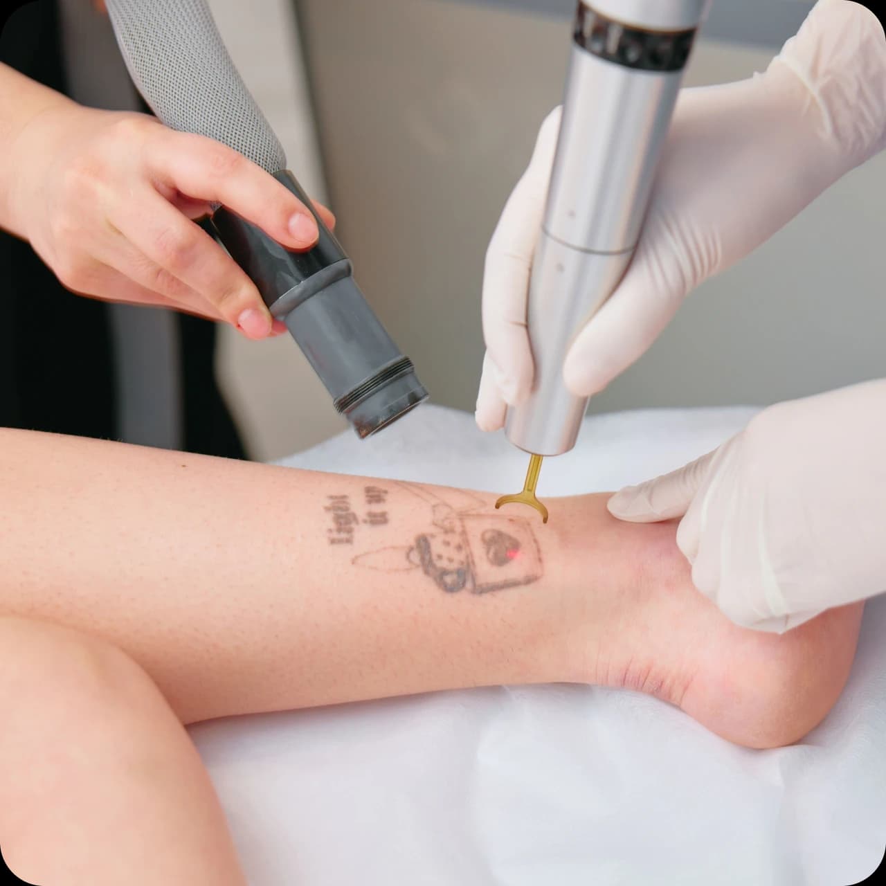 Tattoo removal